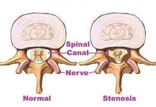 Spinal stenose gir minsket rom i spinalkanalen